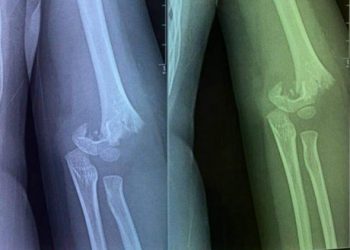 Hà Nội: Mẹ bàng hoàng nhận tin con gái 5 tuổi gãy xương tay khi đang trong giờ học