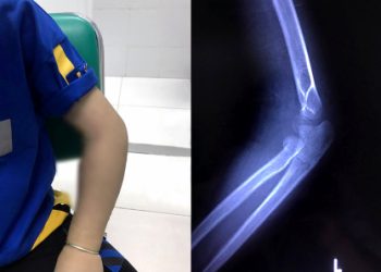 Kiêng cữ đầu năm, nhiều người bệnh trở nặng mới đi cấp cứu