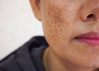 NÁM DA LÀ GÌ?  NÁM DA CÓ ĐIỀU TRỊ ĐƯỢC KHÔNG?